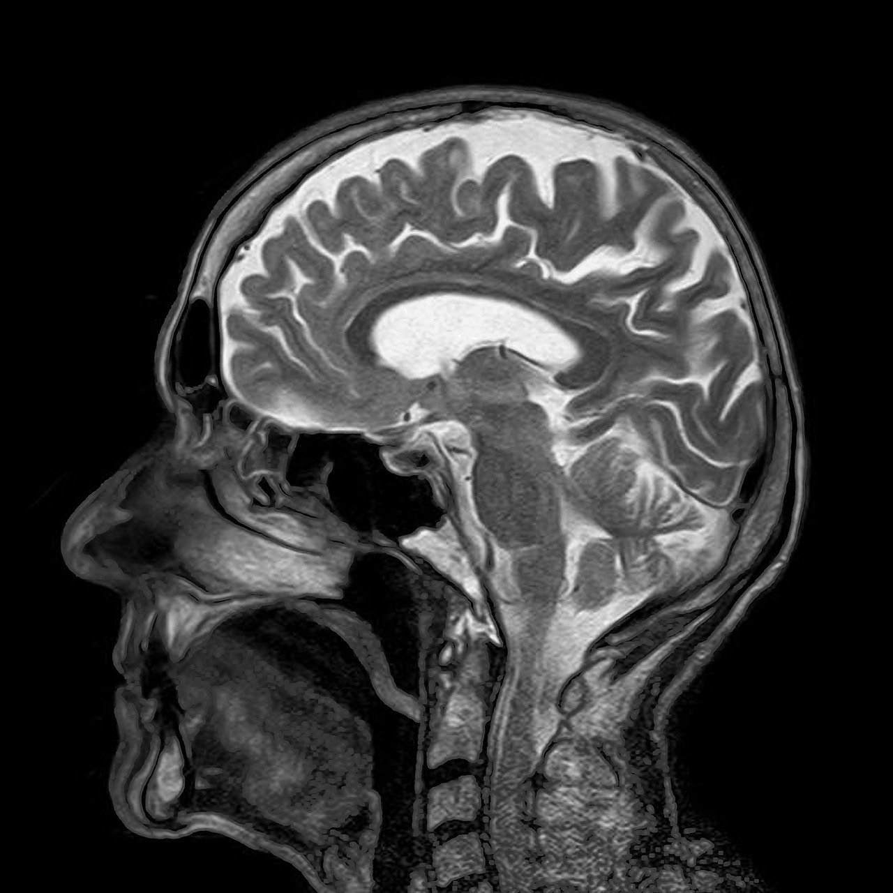 MRI image of a brain.